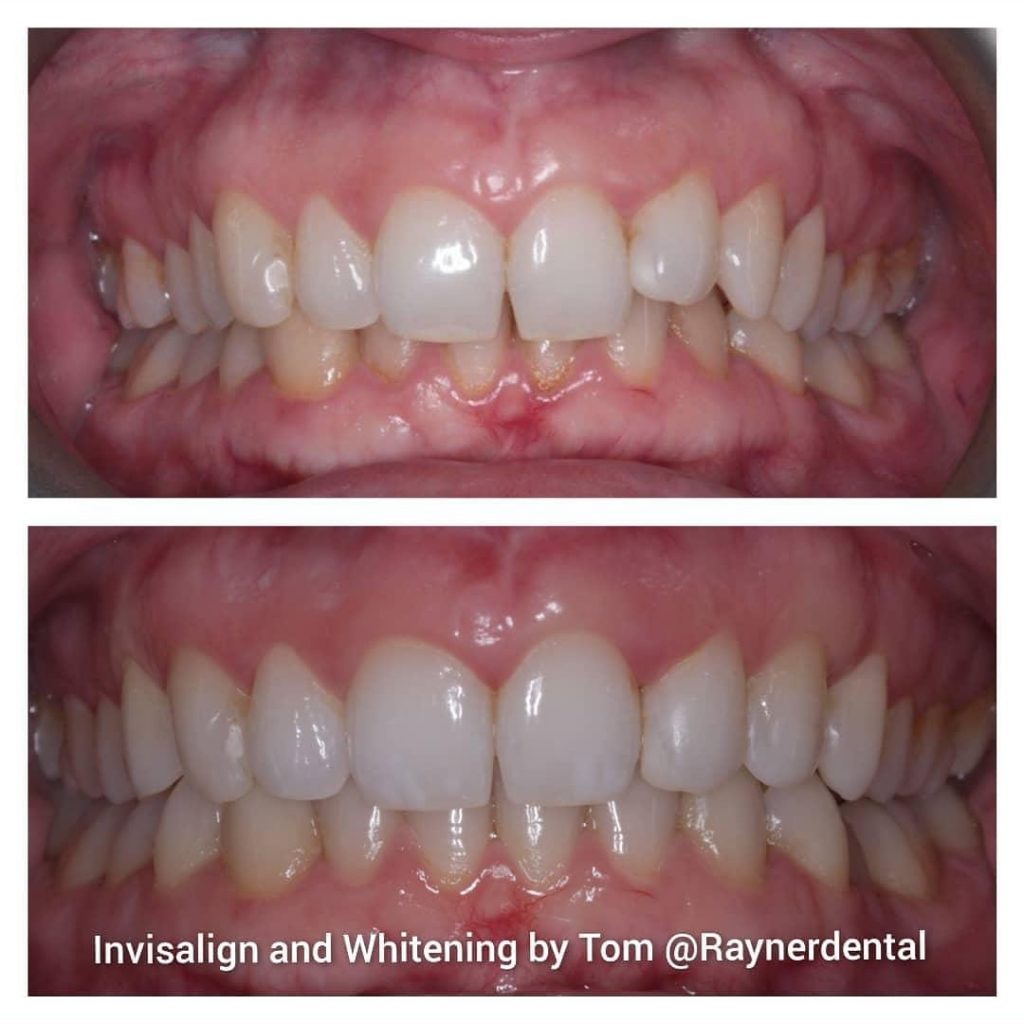 Invisalign and Whitening by Tom