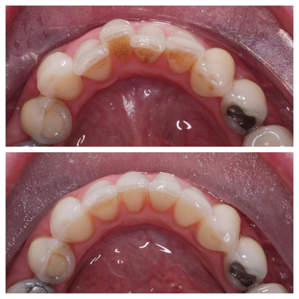 Whitening Stain removal and Invisalign